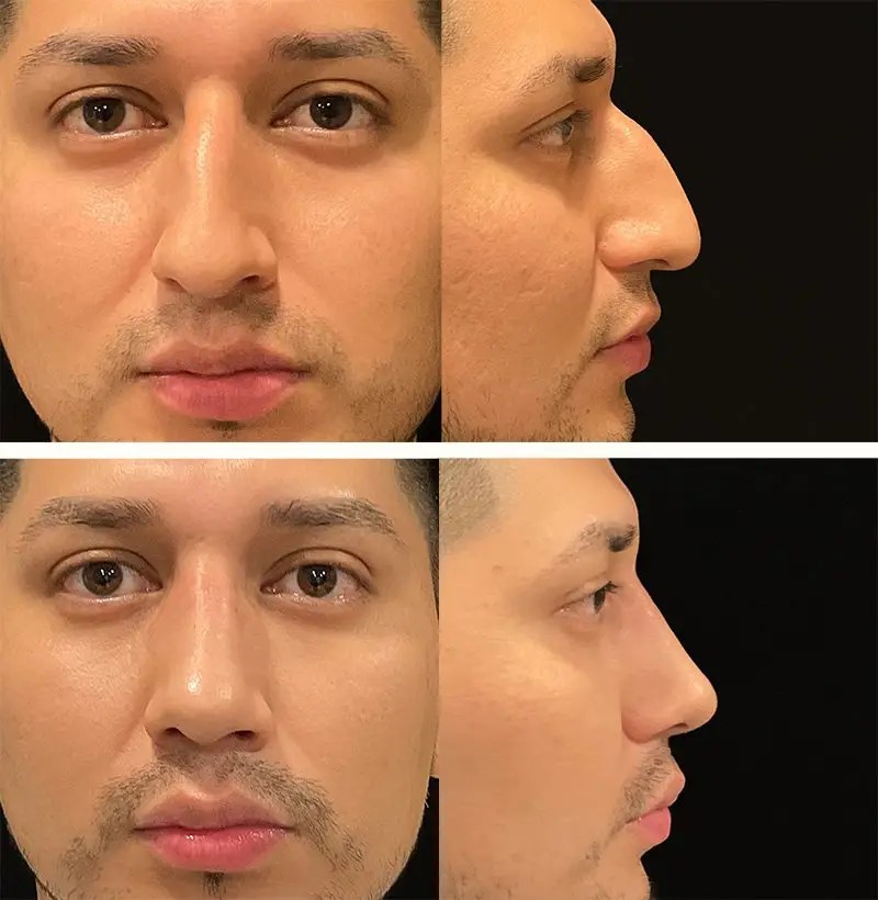 Male rhinoplasty before and after photos, patient 91