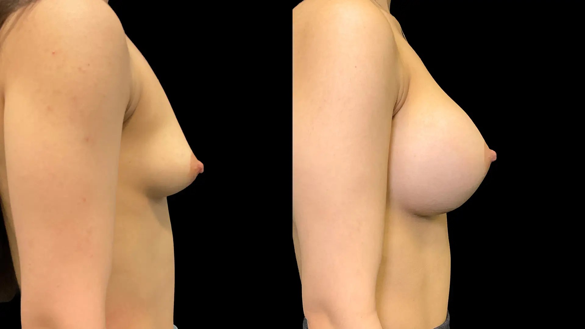 Breast augmentation before and after photos, right side view