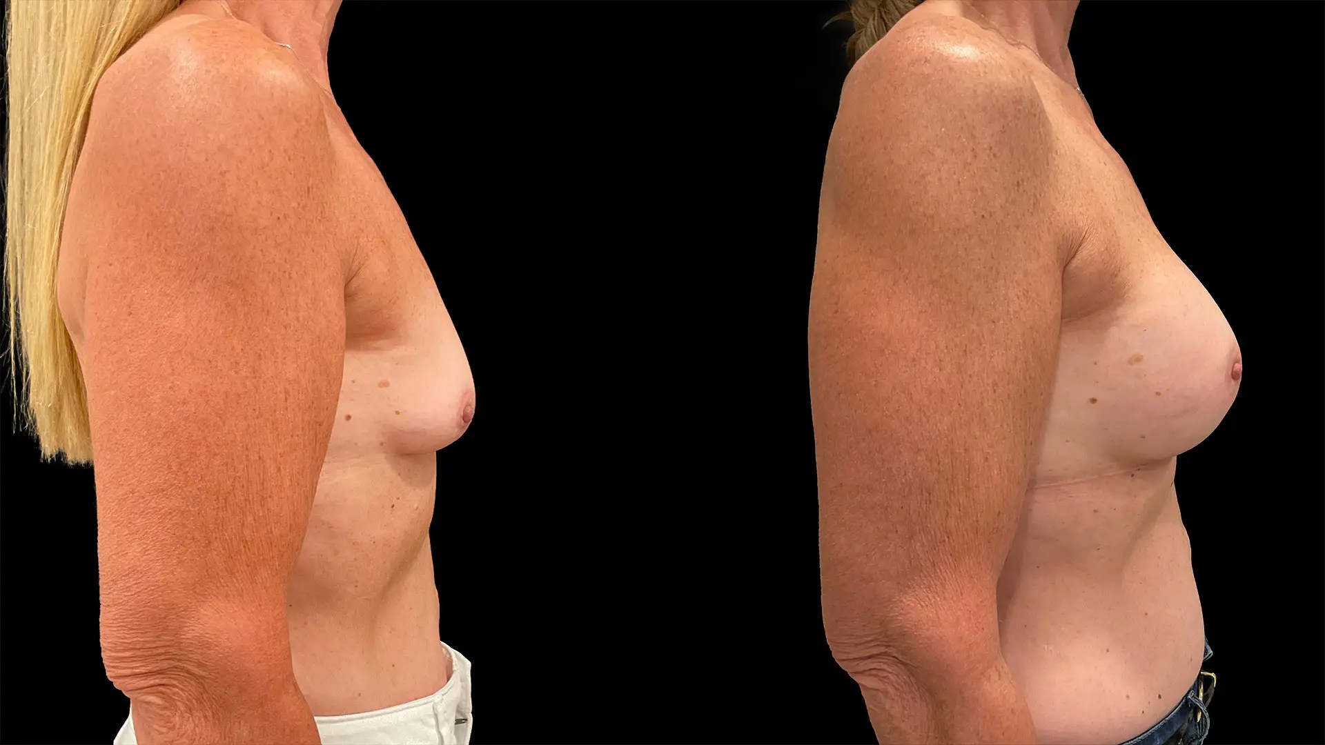 Breast augmentation before and after photos, right side view