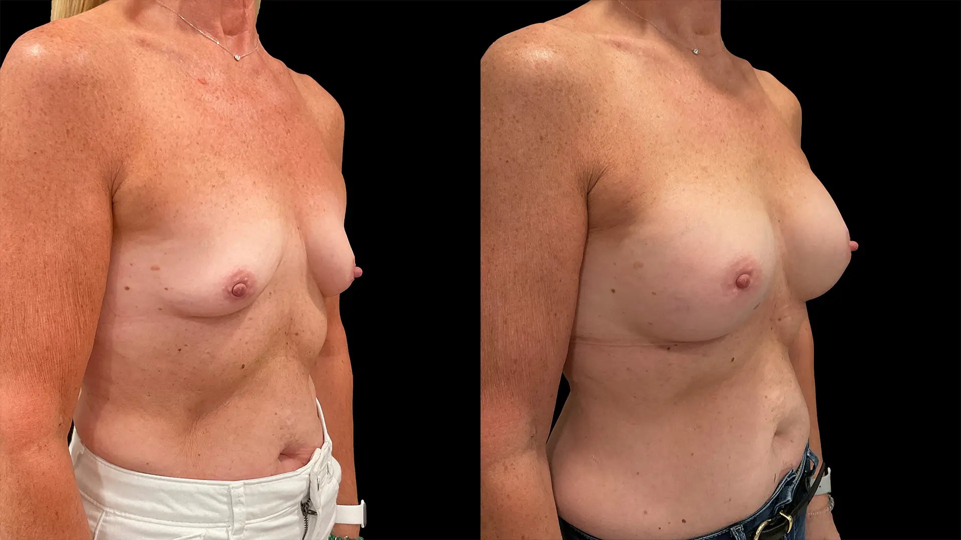 Breast augmentation before and after photos, right oblique view