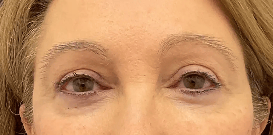 Close up shot of a woman's eyes after upper blepharoplasty surgery