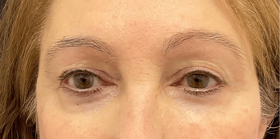 Close up shot of a woman's eyes before upper blepharoplasty surgery