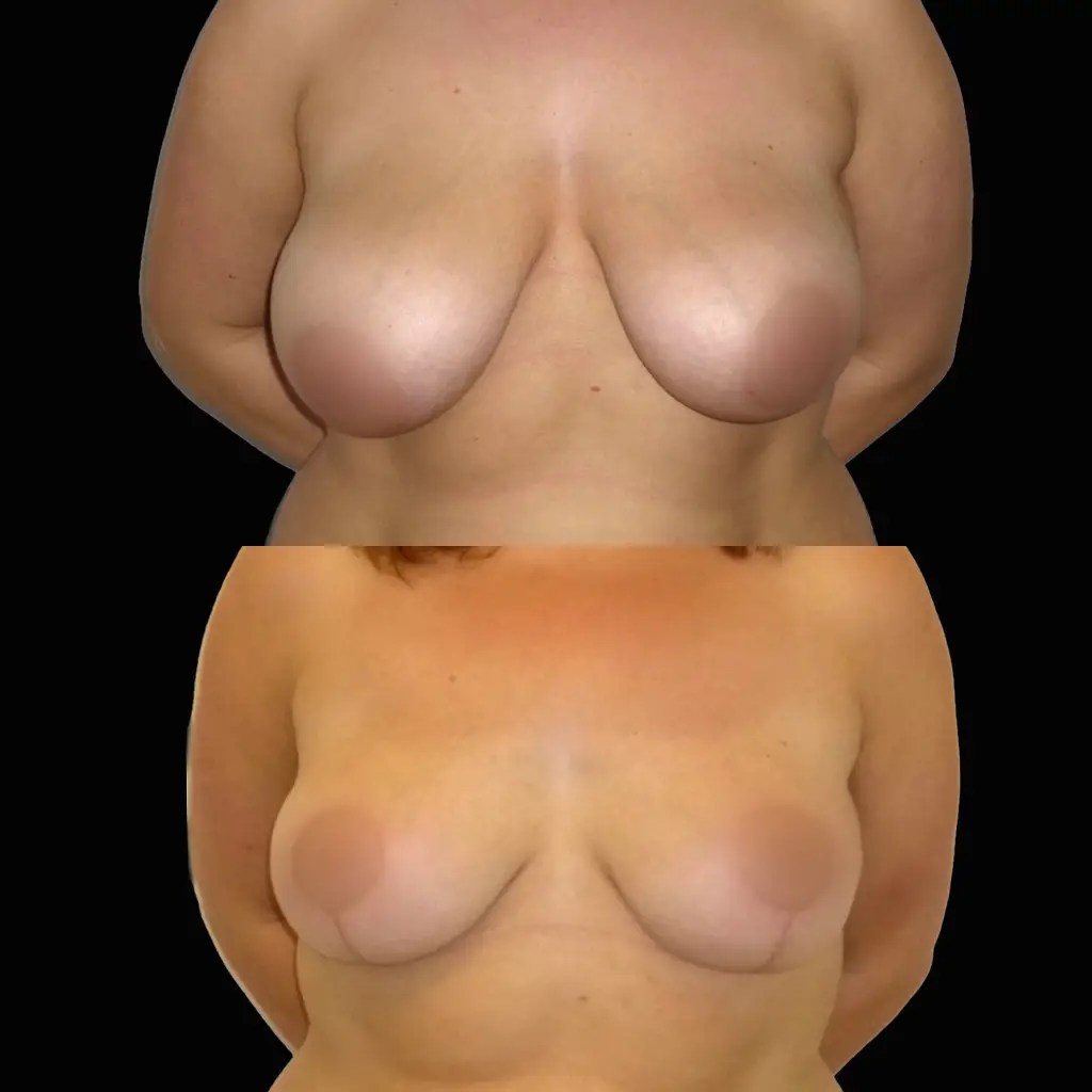 Breast reduction before and after photos