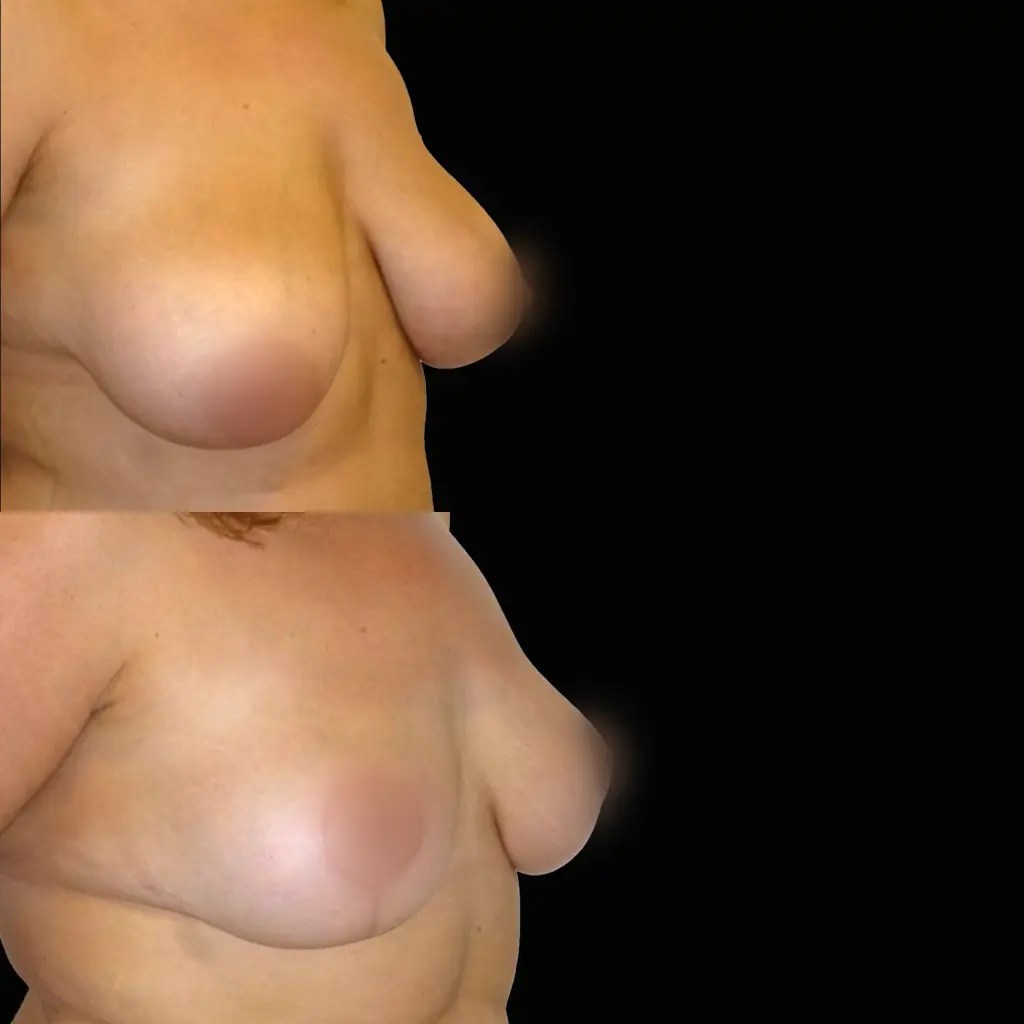 Breast reduction before and after photos