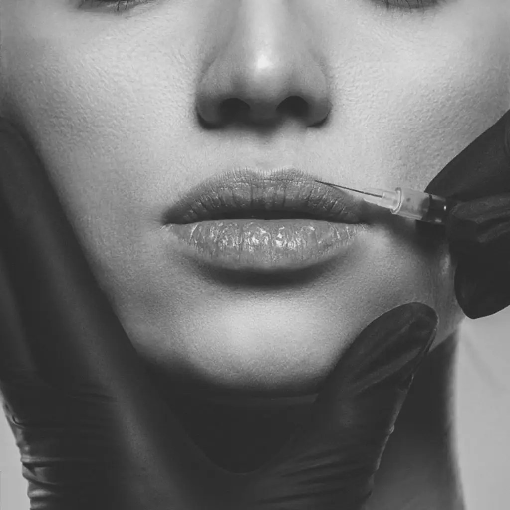 Close-up of lips receiving a dermal filler injection