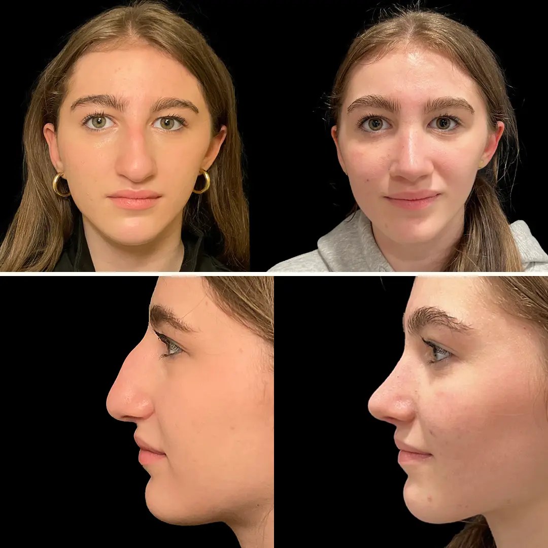 Rhinoplasty before and after photos, patient 117