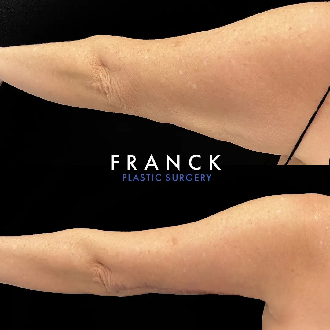 Arm lift (brachioplasty) before and after photos, left arm, back view