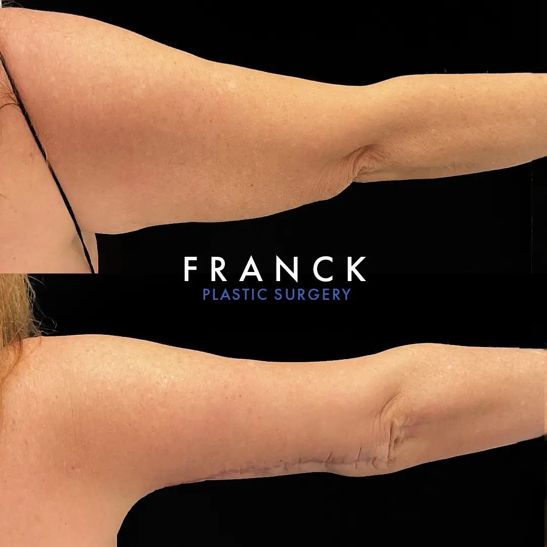Arm lift (brachioplasty) before and after photos, right arm, back view