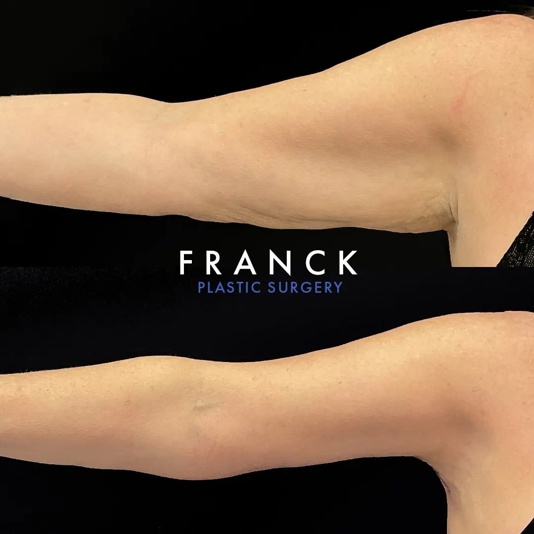 Arm lift (brachioplasty) before and after photos, right arm, front view