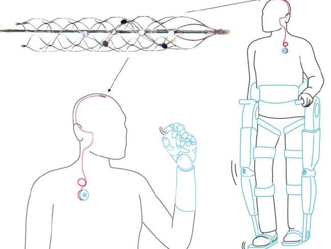 The stentrode is inserted into the blood vessel using a catheter. Source: Supplied