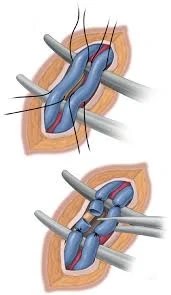 Varicele, denumite si vene varicoase, sunt vene . Arhive Pret Operatie Varicocel Medlife Dr Gabriel Matei