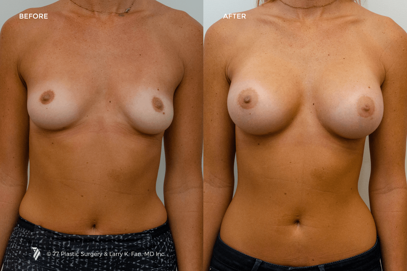 San Francisco Breast Augmentation 22018