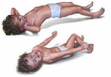 convulsion in children