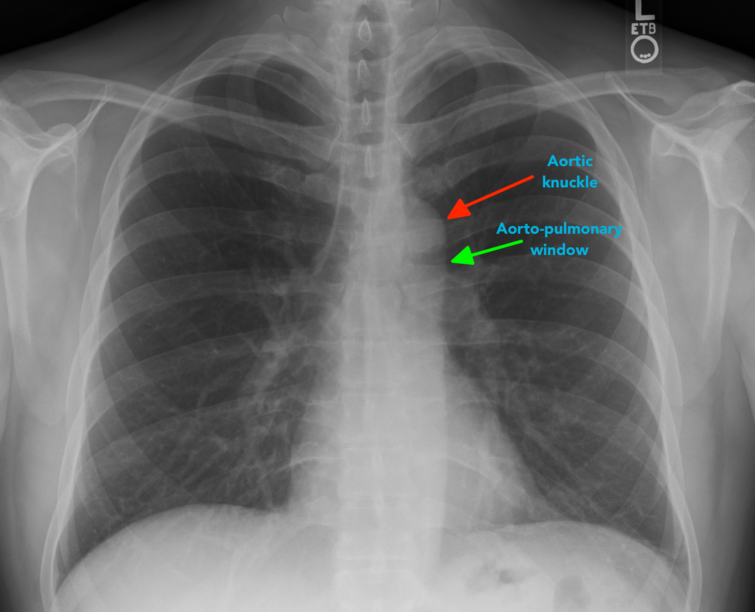 Chest X Ray Interpretation A Structured Approach Radiology Osce