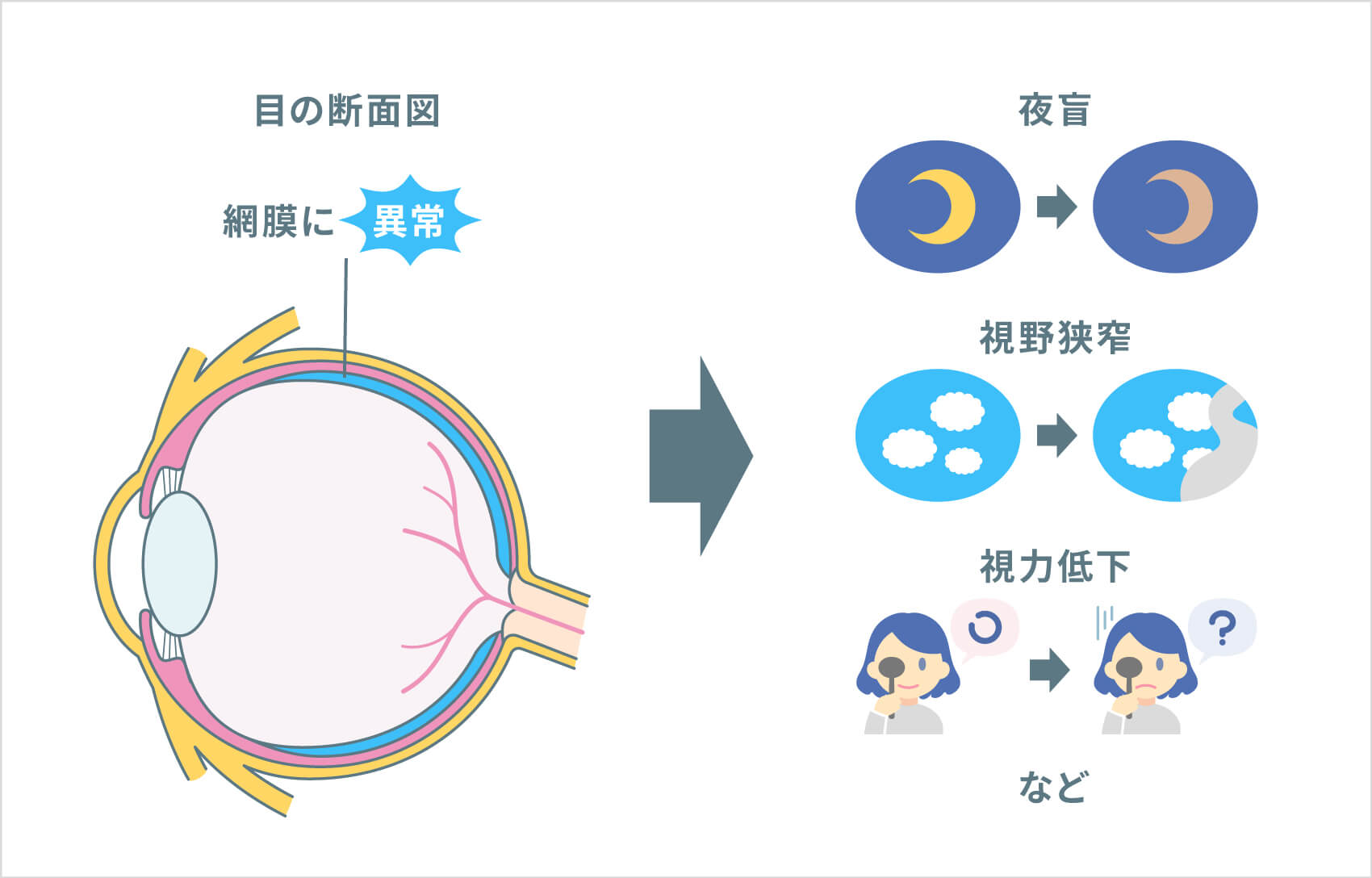 網膜 色素 変性 症 と は