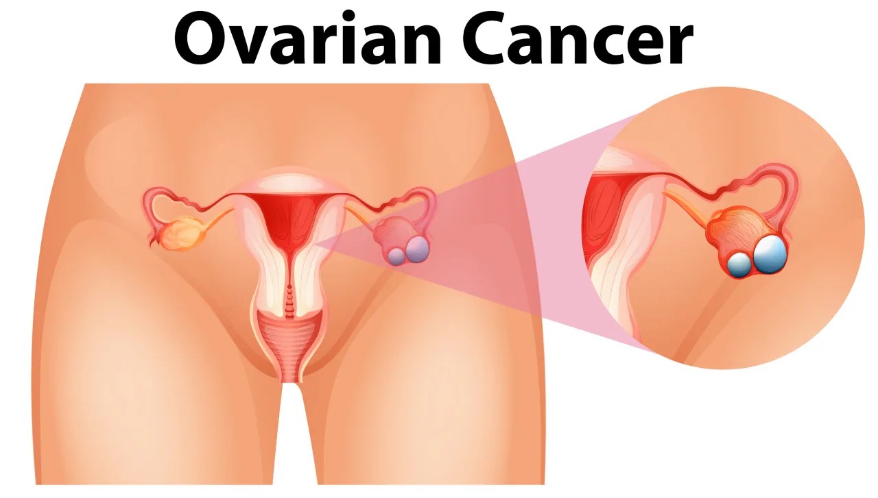 Signs Of Ovarian Cancer That Most Women