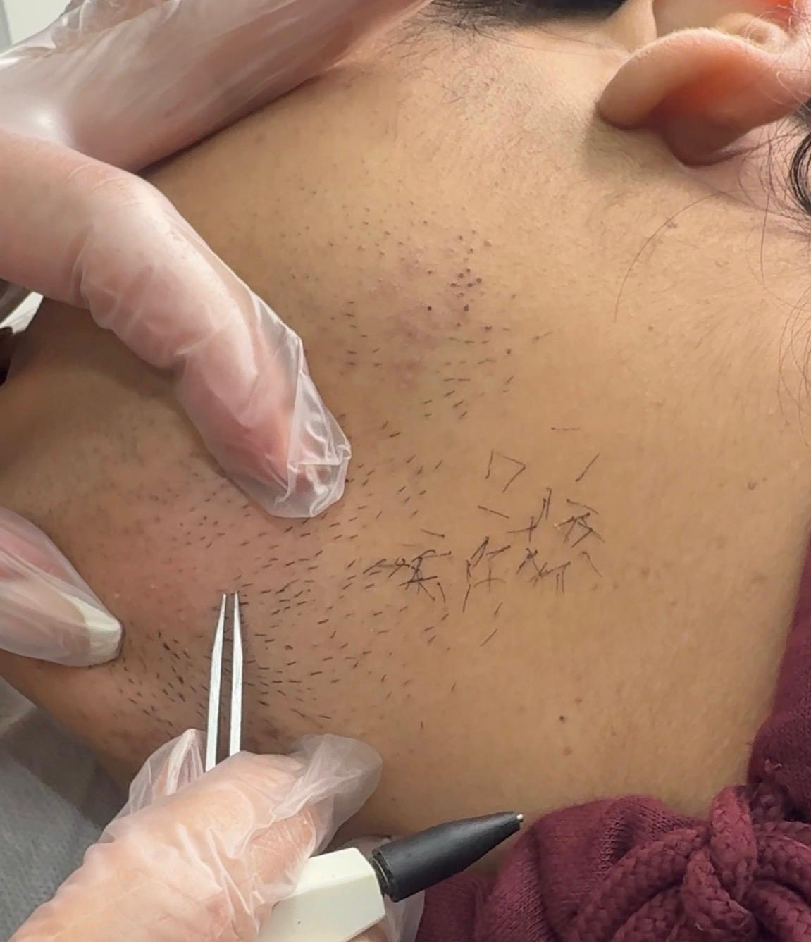 Electrolysis hair removal before and after results