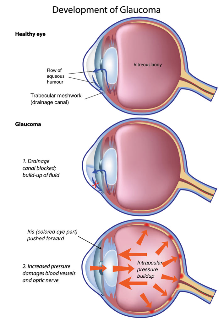 Laser Iridotomy For Glaucoma Glaucoma Associates Of Texas