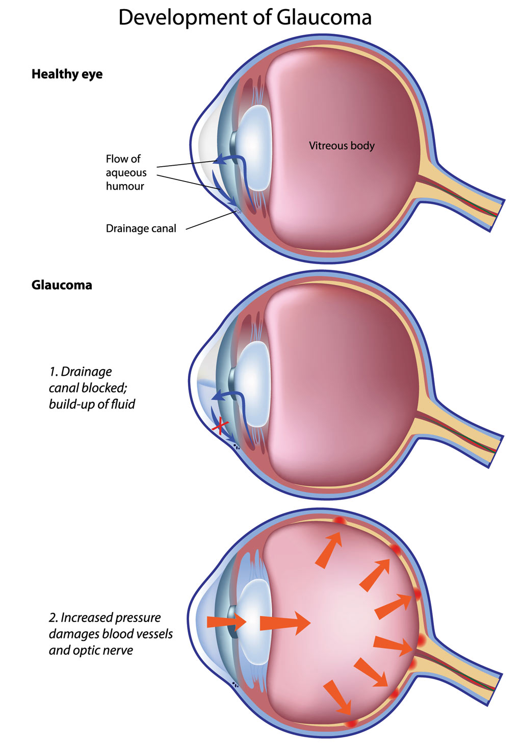 Battery-Free Contact Lens for Glaucoma: Pressure Detection and Drug Delivery Clinical Context for Glaucoma