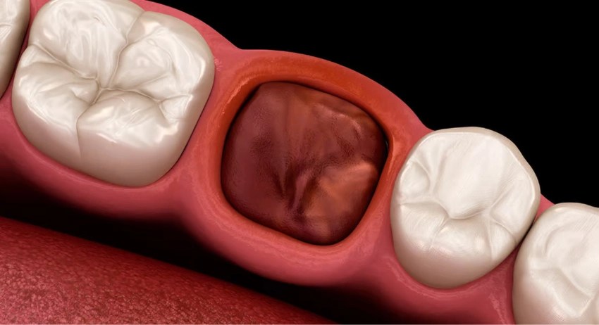 Gap for tooth extraction