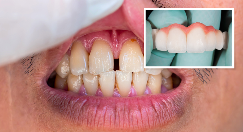 How to Fill Gaps Between Teeth: Your Guide to Diastema