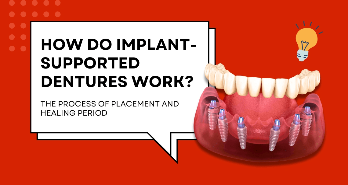 How Do Implant-Supported Dentures Work