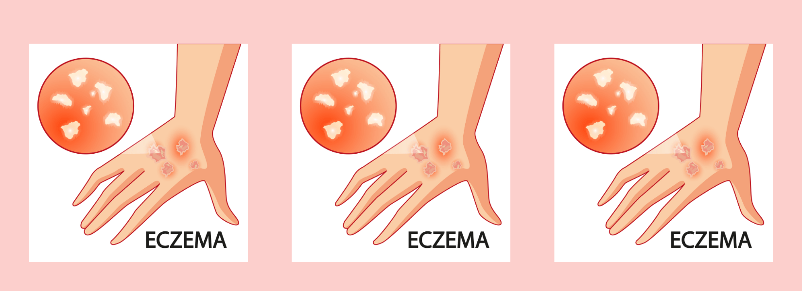 eczema creams