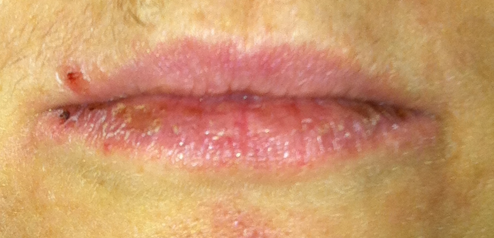 Roaccutane Page 2 A Bit of This A Bit of That