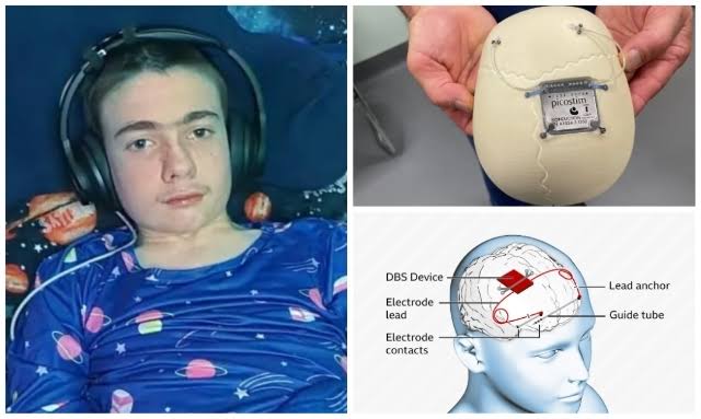 13-Year-Old Becomes World's First to Trial Revolutionary Epilepsy Treatment