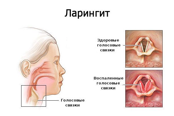 Болит горло поднялась температура как лечиться. Боль в горле с температурой: лечение