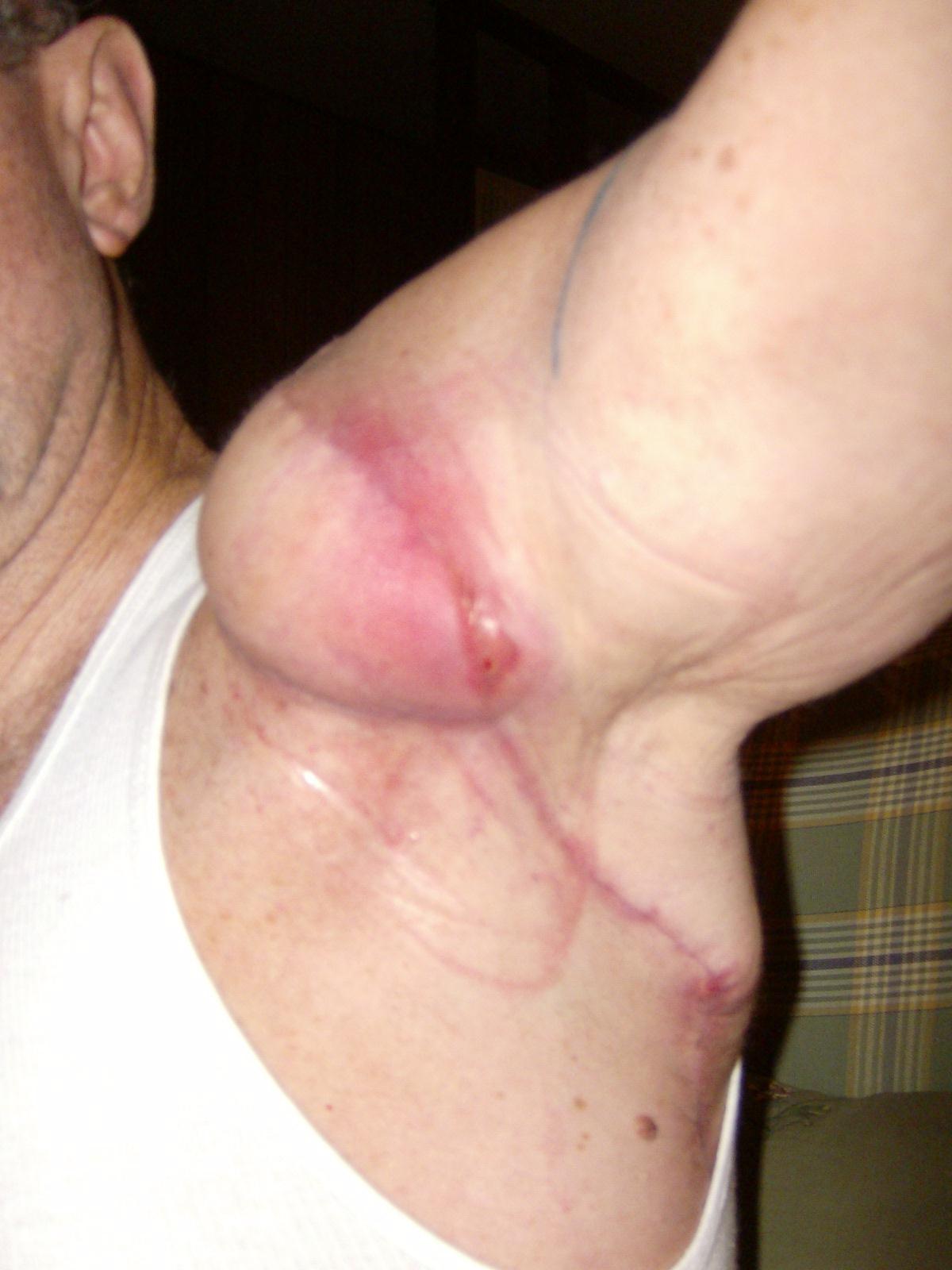 Post-surgery melanoma