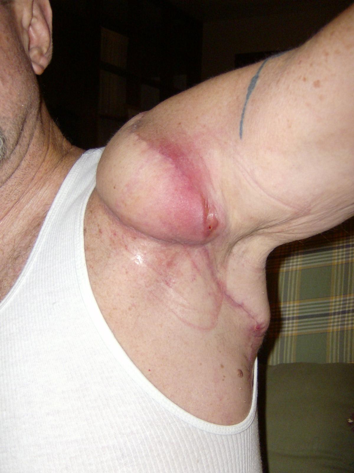 Post-surgery melanoma