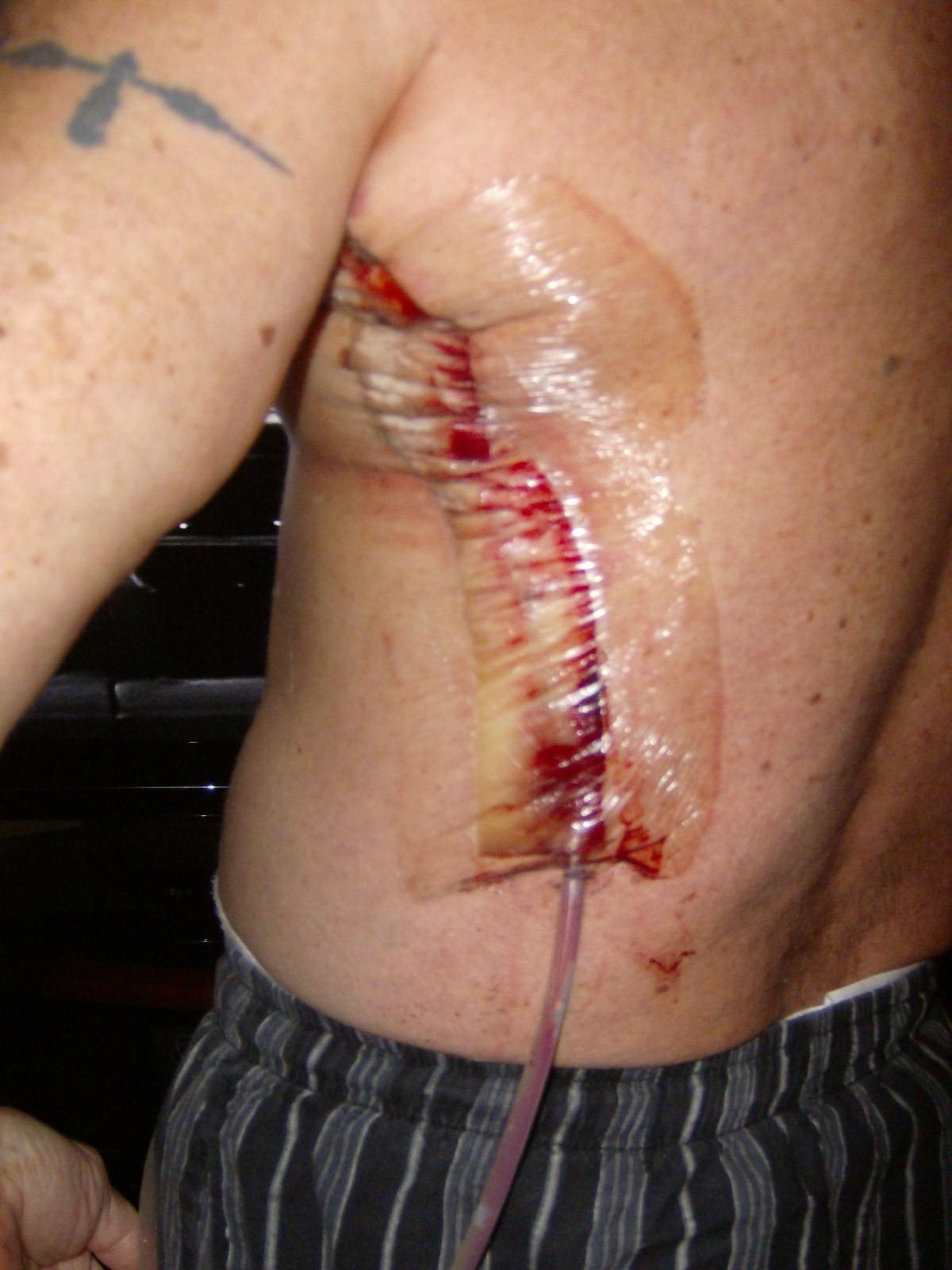 Post-surgery melanoma-back