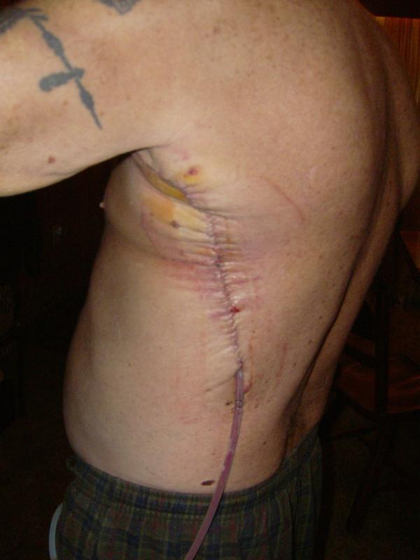 Healing (drain still in)