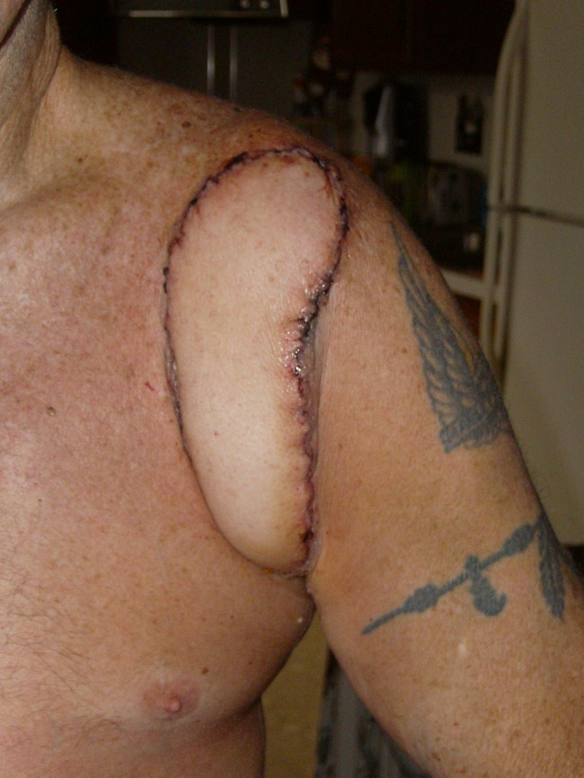Post-surgery melanoma