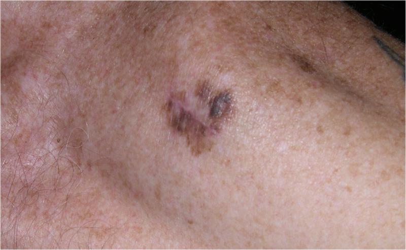 Melanoma - left shoulder
