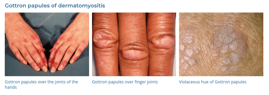 Dermatological manifestations of cancer