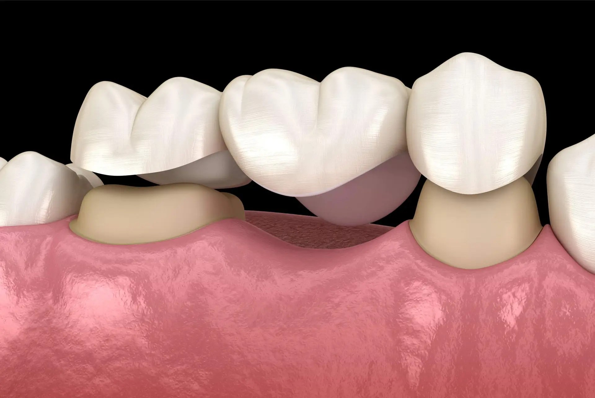 3d Render showing lower Posterior bridge prep