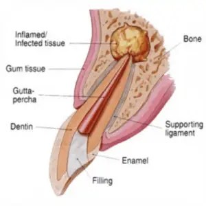 Apicoectomy