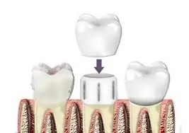 Dental Crown