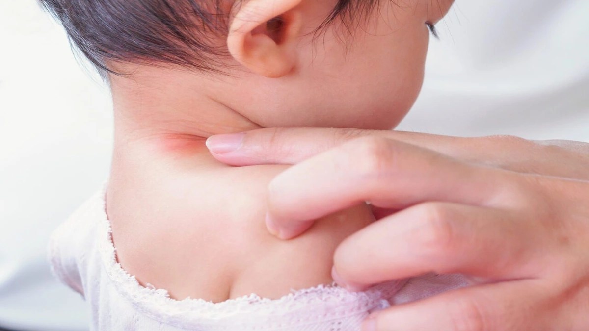 शिशु की गर्दन पर रैशेज होने पर इन टिप्स को जरूर करें फॉलो: Prevent Neck Rash in Baby