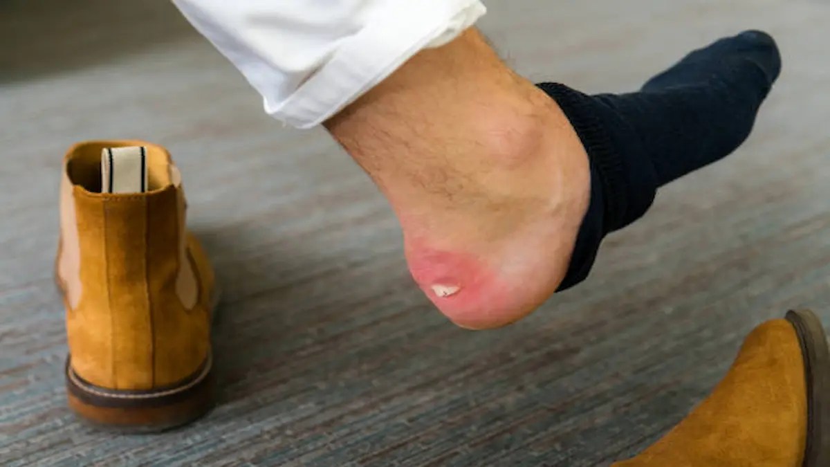 how to prevent shoe bite with easy home remedies
