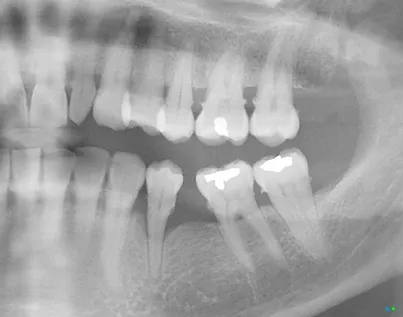 This image is to show what bone loss looks like around teeth as well as what tartar buildup below the gumline looks like