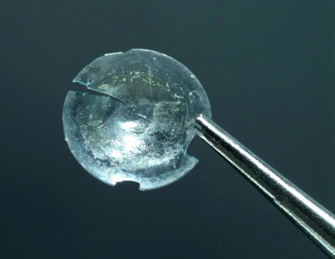 Người phụ nữ bị kẹt kính áp tròng trên mí mắt gần 30 năm mà không hề hay biết - Ảnh 2.