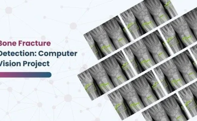 Bone Fracture Detection: Computer Vision Project | GTS