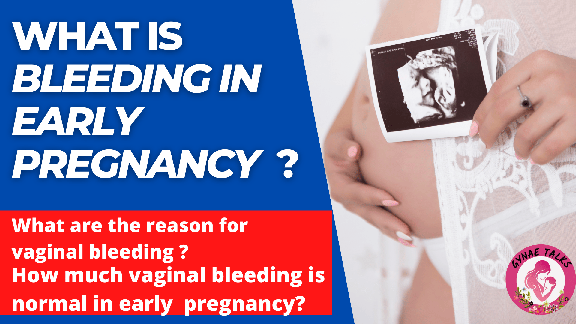 BLEEDING IN EARLY PREGNANCY - Pregnancy, Gynaecology & Health and More