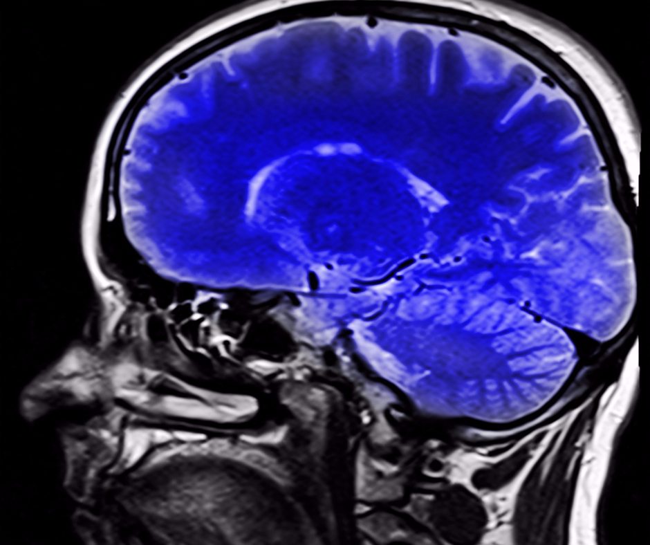 Neuroscience The shocking impact narcissistic abuse has