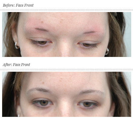 Get Surgery Inspiration from Celebrities – Hair Transplant Place