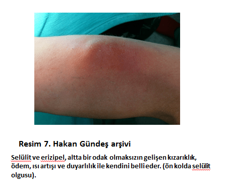 Mantar Enfeksiyonunun Onune Gecme Yollari Anadolu Saglik Merkezi