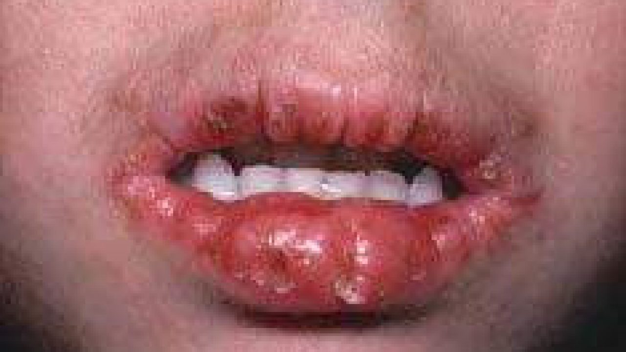 11 Cara Mengobati Bibir Bengkak Yang Jarang dilakukan - HaloSehat